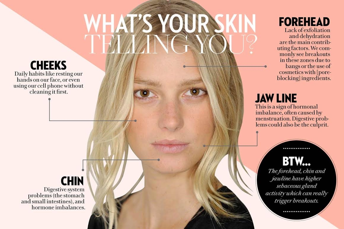 This acne face map explains WTF is causing your breakouts