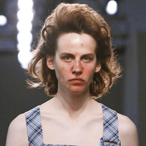 Having Acne Could Mean You'll Live Longer and Look Younger Than People With Clear Skin