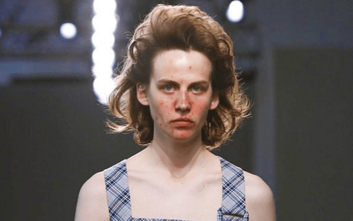 Having Acne Could Mean You'll Live Longer and Look Younger Than People With Clear Skin