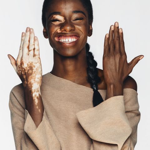 How Dermablend is Making Everyone Feel Comfortable in Their Own Skin