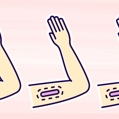 Health Canada Just Approved the Birth Control Arm Implant