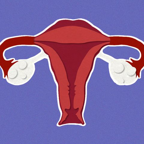 Everything You Need to Know About PCOS