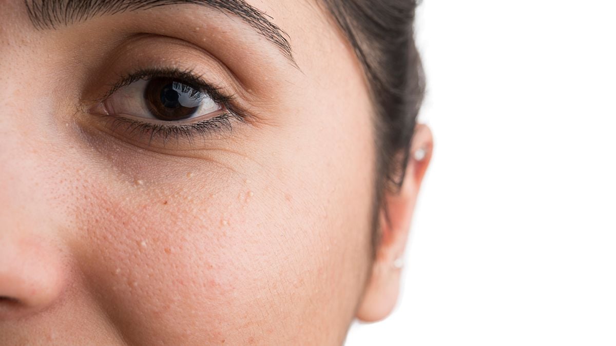 Everything You Need to Know About Milia - FASHION Magazine