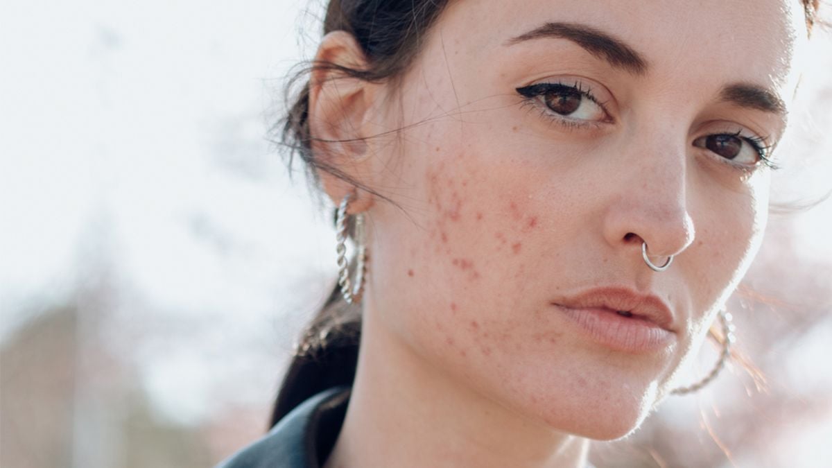 How to Deal with a Skin Allergy Outbreak Stat