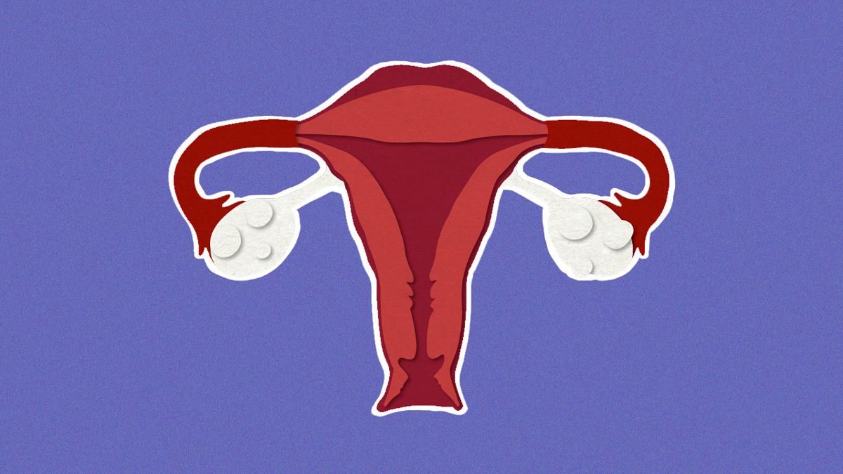 Everything You Need to Know About PCOS