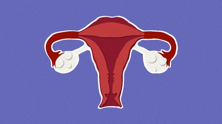 Everything You Need to Know About PCOS